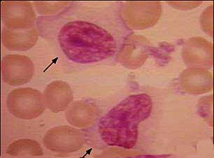 Hepatitis A (infectious hepatitis) Virus