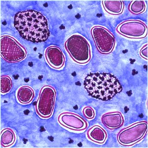 malaria