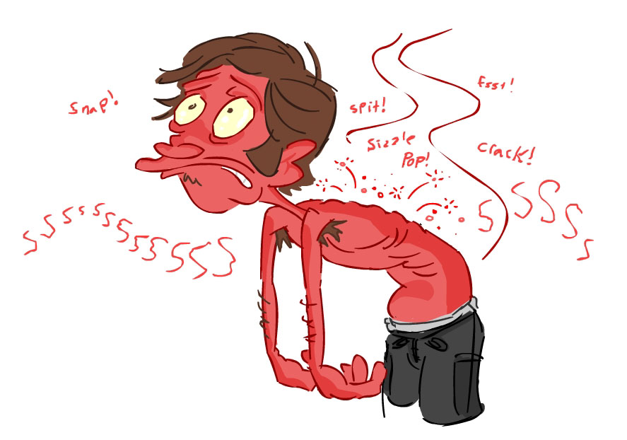 sunburn
